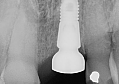 Immediate Implant Anterior After 2