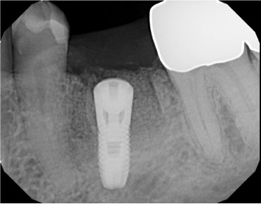 Immediate Implant Posterior After