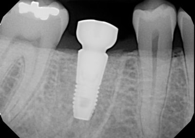 Implant After 1