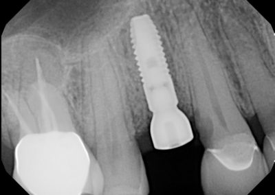 Implant After 2