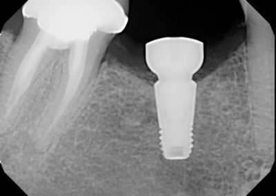 Implant After 3